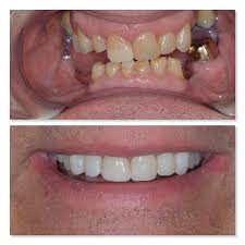 We did not find results for: A Life Changing Outcome Using Dental Implants Infinity Dental Clinic