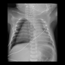 A pneumothorax can be caused by: Pediatric Imaging On Twitter Pneumothorax Note Tension Pneumothorax Is Diagnosed When There Is Mediastinal Shift Which Implies Underlying Tension Complications Tension Pneumothorax Causes Torquing Of Great Vessels Vascular Compromise Requires