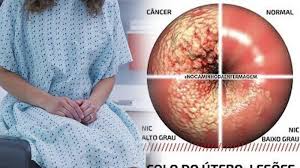 Tidak ada tes darah untuk hpv, tetapi beberapa tes dapat membantu penyedia layanan. Perlunya Tes Pap Smear Bagi Wanita Yang Aktif Berhubungan Seks Jika Tidak Kanker Serviks Menghantui Tribun Cirebon