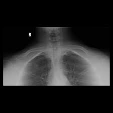 Whether you're driving locally or embarking on a road trip, it helps to know about driving conditions. Chest Ap Lordotic View Radiology Reference Article Radiopaedia Org