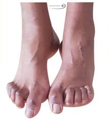 Charcot foot is a progressive condition that involves the gradual weakening of bones, joints, and soft tissues of the foot or ankle. Charcot Marie Tooth Symptome Ursachen Behandlung Gelenk Klinik De