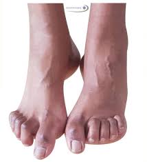 95 % prozent aller patienten sind diabetiker. Charcot Marie Tooth Symptome Ursachen Behandlung Gelenk Klinik De