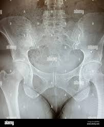 Image result for Hip XRay