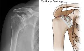 Image result for Shoulder XRay