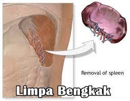 Jadi, cobalah pertahankan postur tubuh anda dengan banyak bersandar ke belakang. Obat Herbal Untuk Menyembuhkan Limpa Bengkak