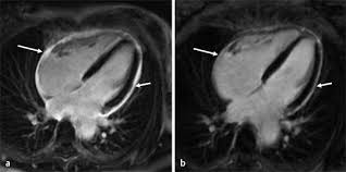Emb ≤2 wochen wenn ef <50%. Klinischer Nutzen Einer Kardio Mrt Untersuchung Bei Patienten Mit Akutem Myokardinfarkt Springerlink