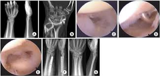 Ulnar Shortening Osteotomy As A Treatment Of Symptomatic Ulnar Impaction  Syndrome After Malunited Distal Radius Fractures | Archives Of Orthopaedic  And Trauma Surgery