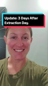 Update: 3 Days after extraction day....its been rough today but I got this!  Hoping this is the worst of it and I'll be all healed up soon! #update  #healing #process #tooth #extraction #igotthis