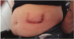 Image result for Intrathecal Pump