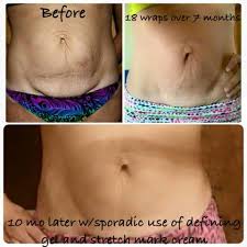 Bio Oil Results On Stretch Marks Before And After Craaaaazy These Amazing Wraps Helped To Tighten Her Loose Skin And Check Out How Her Results A Defining Gel It Works Defining Gel Combination Skin Face Wash