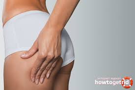 Hovedårsaken til ujevn knollhud i lår, rumpe og mage er et. Slik Fjerner Du Cellulitter Fra Frosker Og Rumpe