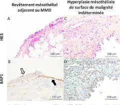 Maybe you would like to learn more about one of these? Brca1 Associated Protein 1 Bap1 Expression In Pleural Diffuse Malignant Mesothelioma A Comparative Cytological And Histological Analyses On 50 Patients Semantic Scholar