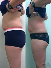 Testosterone replacement therapy (trt) is prescribed to patients with disorders caused by you can take a look at julia's testosterone results before and after. Before After Pics Body Sculpting And Beauty Too Facebook