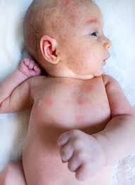 Image result for sweat rash on back baby