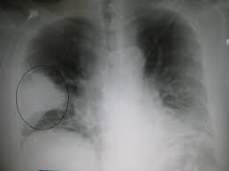 Pneumonia is a respiratory infection characterized by inflammation of the alveolar space and/or the interstitial tissue of the lungs. What You Don T Know About Pneumonia It Is The Big Killer For People Of Any Age