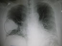 In 1967, a previously unknown virus infected laboratory workers doing research involving. China Rules Out Sars In Mystery Viral Pneumonia Outbreak