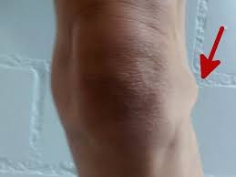 Meniskusganglion Eine Schwellung Am Meniskus Knie Marathon Knie Op Reha Patienten Aufgepasst