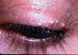 Image result for milium cyst on eyelid