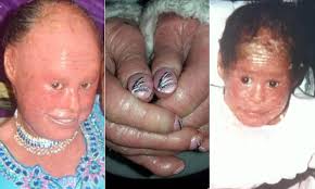 Harlequin ichthyosis is a very rare disorder with a very few cases reported in literature. Coventry Woman Covered In Fish Scales Lives In Pain Due To Harlequin Ichthyosis Daily Mail Online