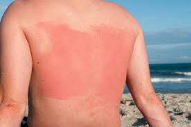 Image result for sweat rash on back