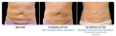 Check spelling or type a new query. Coolsculpting Before After Pictures Mps Mps