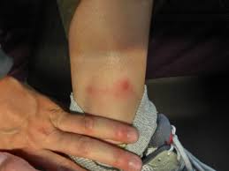 Don't soak the blister in water for at least 24 hours after your. Carolin Liefke On Twitter On The Other Hand Cryogenic Burns By Liquid Nitrogen Are Literally Painful Too Couldn T Walk For Three Days After This One Https T Co Vdcqbbpldl