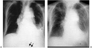 Images from teaching files of afshin karimi, md, phd, jd, assistant clinical professor of radiology, university of california medical center, san diego. Radiology Of The Pleura Thoracic Key