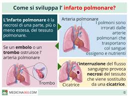 Si ritiene che in assenza di una corretta terapia anticoagulante, oltre il 40% delle trombosi venose profonde determinino embolia polmonare. Infarto Polmonare Cos E Sintomi Cause Terapia E Conseguenze