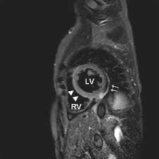 Endocarditis, myocarditis and pericarditis (systemic infection) (medical microbiology and infection). Early Diagnosis Of Acute Viral Myocarditis By Cardiovascular Magnetic Resonance
