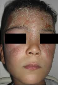Acute localized exanthematous pustulosis