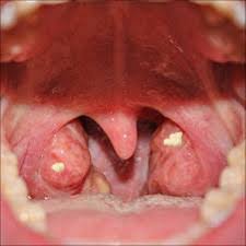Learn how to stop tonsil stones from forming, elimin. Throat Nuts What To Do When You Have Them