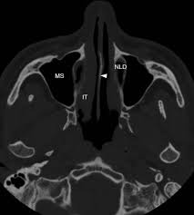 Image result for Maxillary Sinus