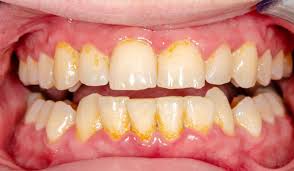 Sensitive + enamel shield, cph healthy fresh How To Get Rid Off Tartar And Plaque Istanbul Dental Care