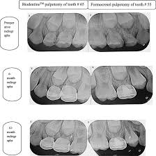 Following pulpotomy, pain intensity was evaluated by use of a visual analog scale at 1 and 7 days from the treatment and in clinical appointments at 3. Biodentine Tm Versus Formocresol Pulpotomy Technique In Primary Molars A 12 Month Randomized Controlled Clinical Trial Bmc Oral Health Full Text
