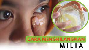 Adakah glowwegirls dan glowweguys memiliki milia? Cara Alami Yang Ampuh Untuk Menghilangkan Milia Terbukti How To Get Rid Of Milia At Home Youtube