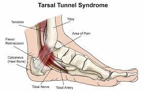Tarsal Tunnel Syndrome Symptoms Causes Diagnosis Prognosis Treatment