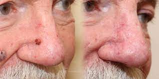 Update your find a dermatologist profile, the academy's directory that's visited by over 1 million people a year. Skin Cancer Removal And Reconstruction On The Nose Deluca Plastic Surgery Albany Ny