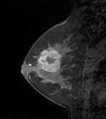 Breast cancer is the most common cancer found in women, but most breast lumps are not cancer. Mri Finding For Triple Negative Breast Cancer In 42 Year Old Woman Download Scientific Diagram