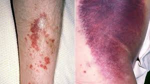 Most skin cancers, however, are curable if they are caught early. Leukemia Rash Pictures Signs And Symptoms Everyday Health