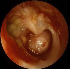 Csom is assumed to be a complication of acute otitis media (aom). Plos Neglected Tropical Diseases Is Chronic Suppurative Otitis Media A Neglected Tropical Disease