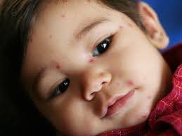 Image result for yellow scabs on the face in children