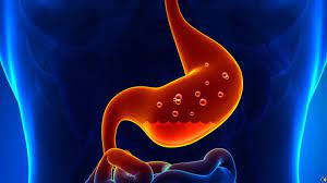 It may occur as a short episode or may be of a long duration. What Is Gastritis What Causes Gastritis What Are The Symptoms How Is Gastritis Treatment