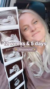 ✨After a very emotional 48 hours, the 12 weeks and 5 days nuchal  translucency scan is complete and went great! We also had such a great  experience with our ultrasound tech. She was incredible. , It ...