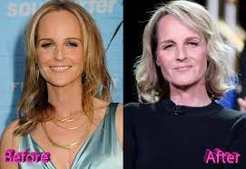 Has deidre hall had plastic surgery? Helen Hunt Plastic Surgery Procedures And Results