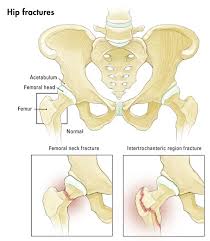 Image result for Fracture