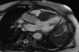 Bei der ultraschalluntersuchung kann die pumpfunktion des herzens beurteilt werden, dies ist für die beurteilung der schwere der erkrankung hilfreich, außerdem wird diese untersuchungsform deshalb auch zur beurteilung des krankheitsverlaufs genutzt. Krankheitsbilder Und Behandlungsverfahren Herzzentrum Der Zentralklinik Bad Berka