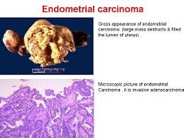 Unfortunately, gross's health scare didn't end there. Female Genital Tract Dr Basim Shehab Ahmed Koilocytosis