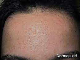 Dermapixel El Tratamiento Topico En El Acne Leve