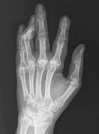 It can affect anyone of any age. Rheumatoid Arthritis Springerlink