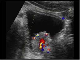 When symptoms of bladder cancer do occur, they include: Urinary Tract And Male Reproductive System 2 2 Bladder Case 2 2 1 Bladder Tumors Ultrasound Cases